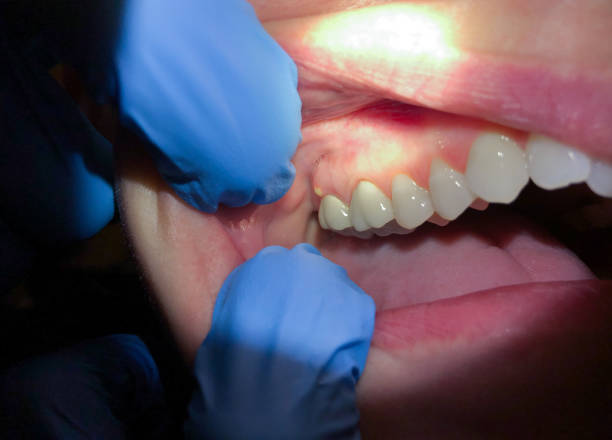 Best Emergency Treatment for Dental Infections or Abscesses in Clear Lake Shores, TX